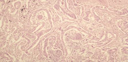 病例2+中分化腺癌