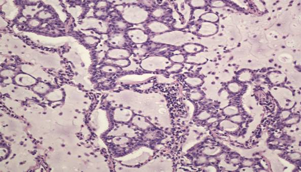 病例3+粘液腺癌+200倍
